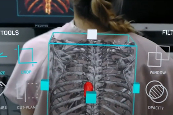 Augmented reality view of a woman's spine made possible by 5G
